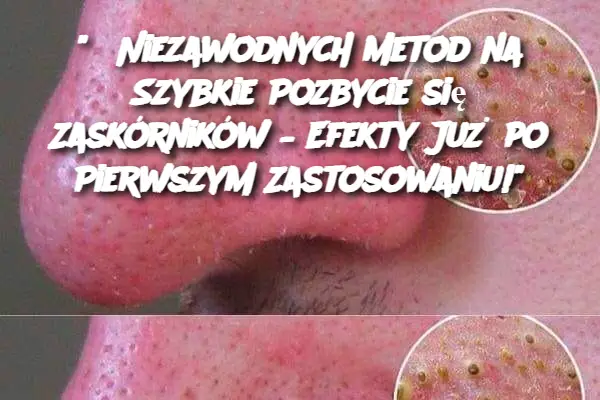 "5 Niezawodnych Metod na Szybkie Pozbycie się Zaskórników – Efekty Już po Pierwszym Zastosowaniu!"