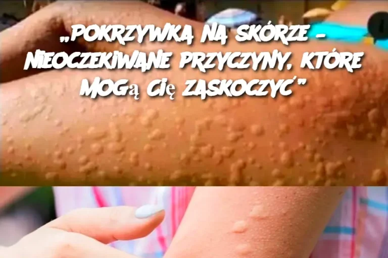 „Pokrzywka na skórze – nieoczekiwane przyczyny, które mogą Cię zaskoczyć”