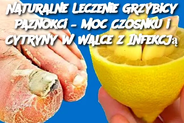 Naturalne Leczenie Grzybicy Paznokci – Moc Czosnku i Cytryny w Walce z Infekcją