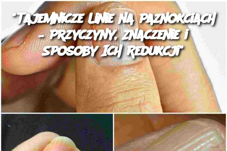 "Tajemnicze Linie na Paznokciach – Przyczyny, Znaczenie i Sposoby Ich Redukcji"