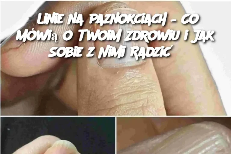 Linie na Paznokciach – Co Mówią o Twoim Zdrowiu i Jak Sobie z Nimi Radzić?